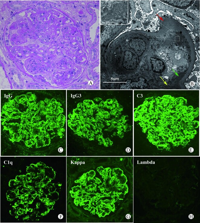 An update of proliferative glomerulonephritis with monoclonal ...