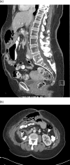 Figure 2 Abdominal CT