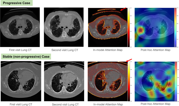 Example cases from the IPF dataset. Top row: case of progressive IPF; bottom row: stable (nonprogressive) case. From left to right, the columns show the first-visit image, second-visit image, in-model attention map overlay on the first-visit image, and post hoc attention map overlay on the first-visit image. Note that the in-model attention map highlights the CT table (arrow), and the post hoc attention map hints that the model focused on the wrong area. These two visualizations imply that the model may be overfitted to acquisition shift and may fail in clinical practice.