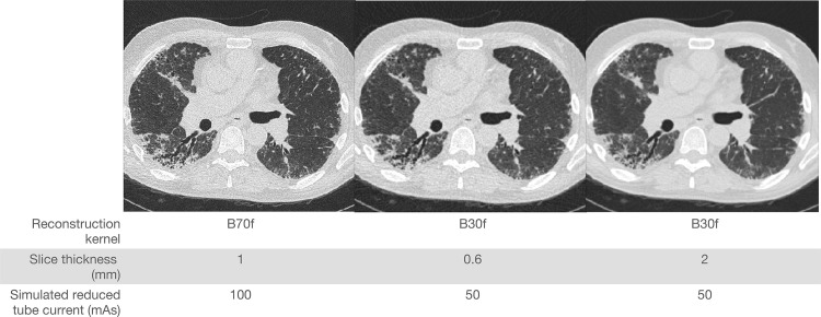 CT images reconstructed differently from CT raw sinogram data collected from one patient. CT protocol information is given for each reconstruction image.