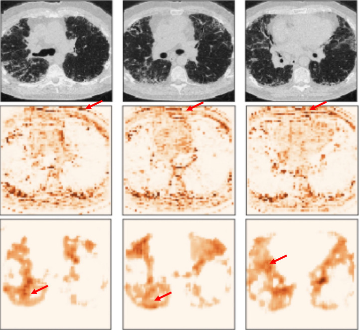 Example cases and corresponding attention maps from two guided attention models for diagnosing IPF from high-resolution CT images. Each column is for each case. Top: CT images. Center: attention maps from the model with area under the curve (AUC) = 0.972. Arrow = higher-attention area of this model. This model focuses outside the lung, raising concern about overfitting to the acquisition shift. Bottom: attention maps from the model with AUC = 0.943. Arrow = focusing of this model on higher attention inside the lung. This model focuses on appropriate areas for distinguishing IPF.