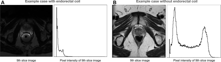 Acquisition shift in example cases of subjects from the public PROMISE12 dataset (21). (A) Axial T2-weighted image and intensity histogram in an example case with an endorectal coil. This case shows shape distortion because of the endorectal coil. (B) Axial T2-weighted image and intensity histogram in an example case without an endorectal coil.