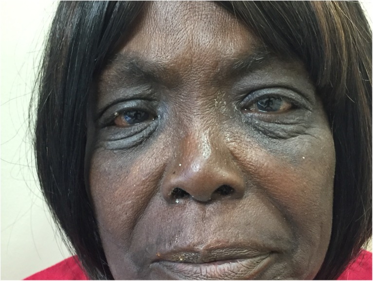 Periorbital edema from apixaban treatment pmc