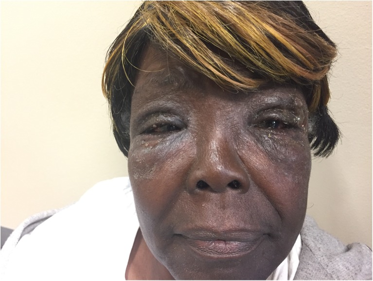 Periorbital edema from apixaban treatment pmc