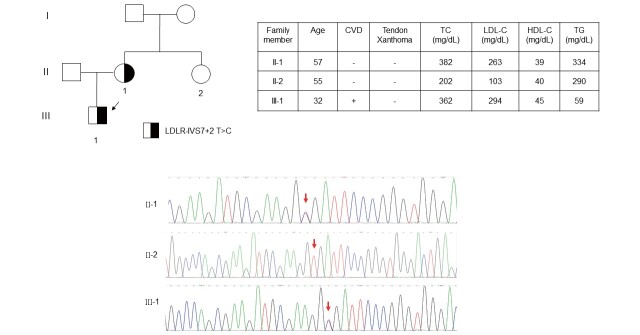 
Fig.3. Family pedigree of LDLR c.1060＋2 T＞C (T＞C at IVS 7＋2)
