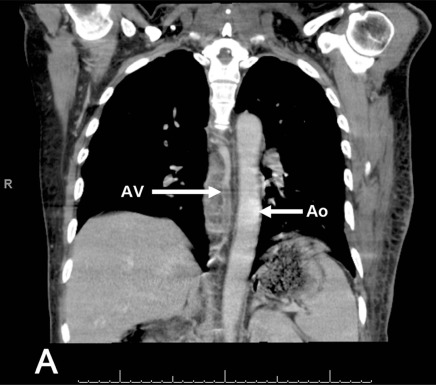 Fig. (1A)