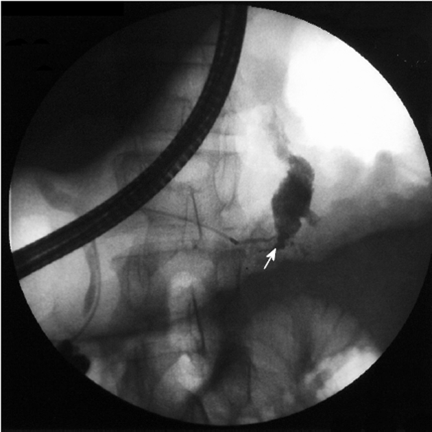 Optimizing Management Of Pancreaticopleural Fistulas Pmc