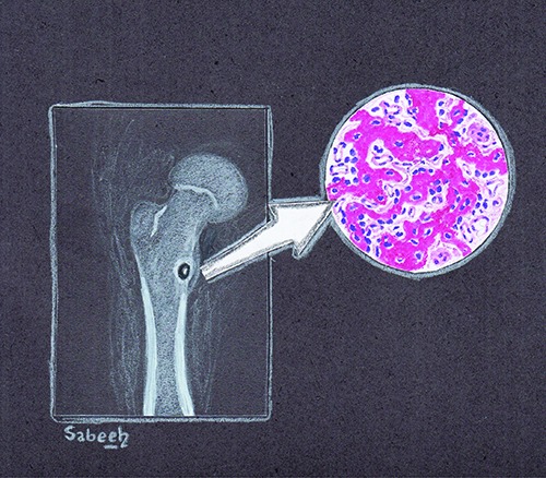 Osteoid osteoma: Contemporary management - PMC