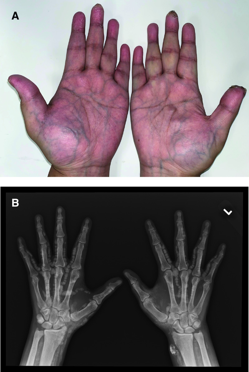 Nodular lesions on the hands of an eskd patient on hemodialysis pmc