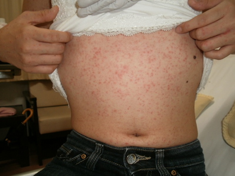 Skin rash in a patient with infectious mononucleosis - PMC