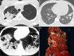 A–D, Chronic granulomatous disease (CGD) in three patients. A, Chest CT image in a young patient with CGD shows a cavitary pneumonia (arrow) in the right upper lobe. B, Chest CT image in a young patient with CGD shows a focus of consolidation (arrow) in the left lower lobe. C, Chest CT image in a child with CGD demonstrates extensive consolidative and cavitary changes throughout the lower lobes (arrows). D, Autopsy specimen of the same patient shows the extensive cavitary/necrotizing foci in the lungs.