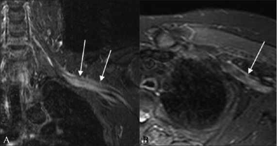 Figure 11 (A,B)