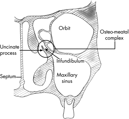 Acute rhinosinusitis in adults: an update on current management - PMC