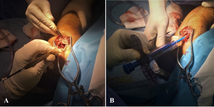 Figure 2. (A) Exposure of the fracture site to prepare the medullary canal, (B) Insertion of the cylindrical iliac bone plug