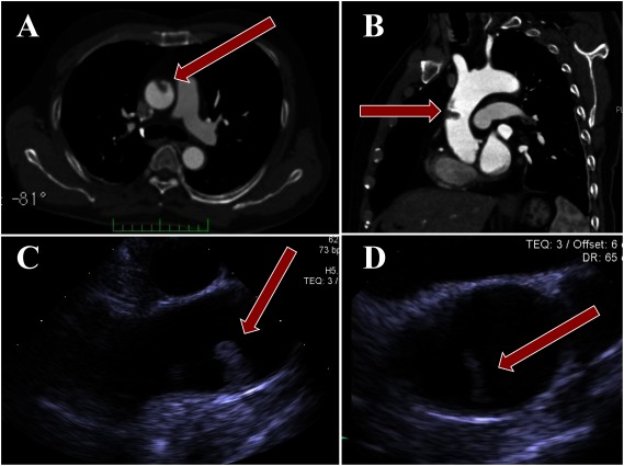 Fig. 1 (A) Axial and (B) left anterior oblique view of the ascending aorta by computed tomography (CT). (C) Long axial and (D) short axial view of the ascending aorta in transesophageal echocardiogram (TEE); the mobile thrombus was shown in CT and TEE (red arrows).