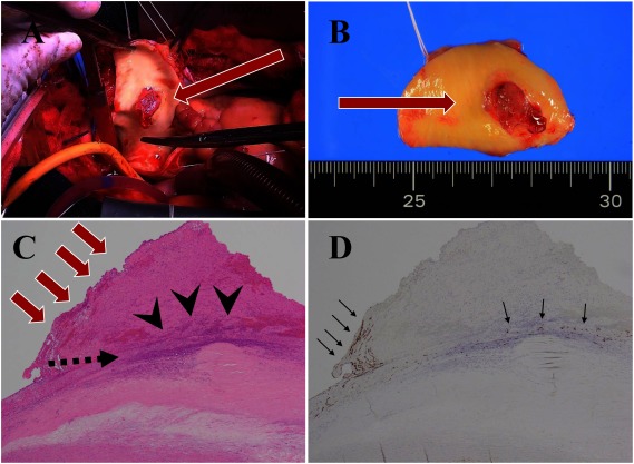 Fig. 2 (A) Intraoperative finding. The thrombus was attached to the ascending aorta (red arrow). (B) Resection of ascending aorta with thrombus (red arrow). (C) Hematoxylin & eosin stain of the resected ascending aorta with thrombus (×40); red arrows show thrombus attached to atherosclerosis plaque in the aorta. There was (not were) an intimal erosion and a ruptured fibrous cap of atherosclerotic plaque (black arrowheads), and the thrombus was on it. (D) Immunostaining for CD34 (×40); CD34-positive regenerated endothelial cells were on the intimal erosion and the thrombus (black arrow).