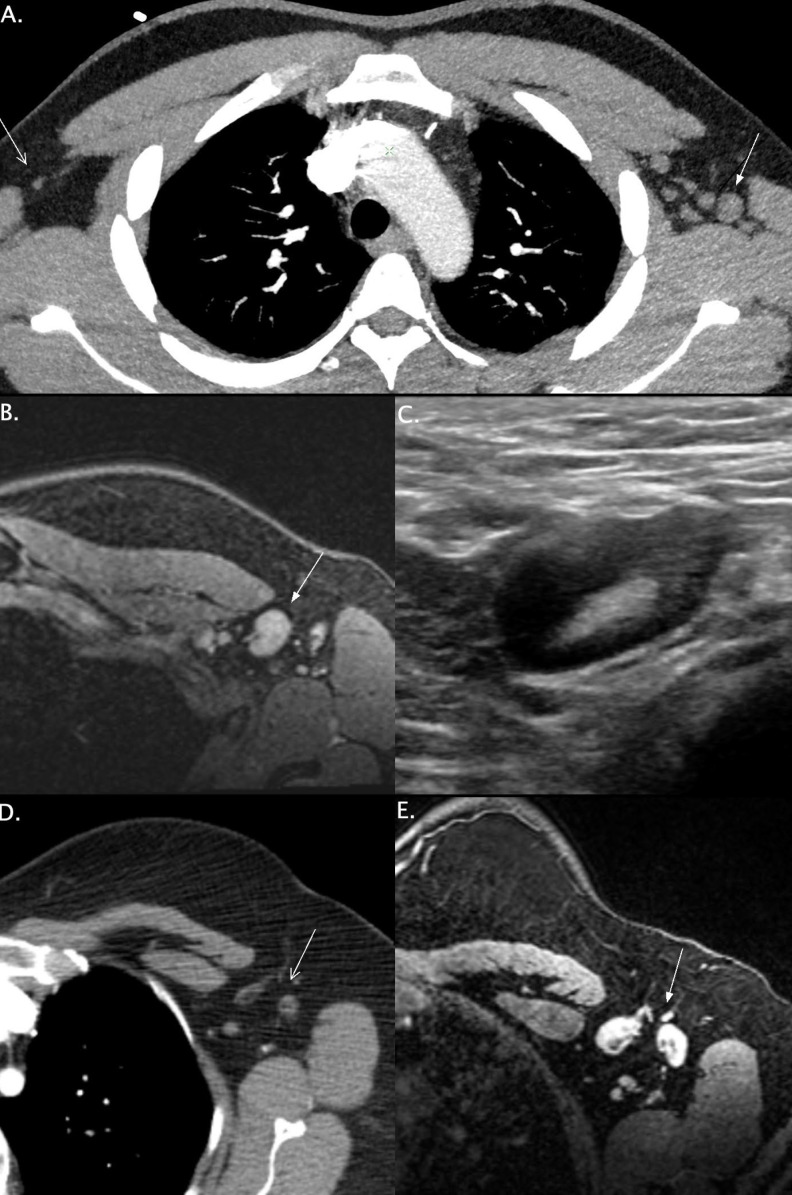 Axial CTA-MIP images demonstrating normal right axillary lymph nodes (A, open arrow) and unilateral left axillary lymphadenopathy (A, closed arrow) 7-days after administration of the second dose of an mRNA-COVID-19 vaccine in a 32-year-old man. The short axis of the lymph nodes measured up to 1.5 cm. Axial breast cancer screening MRI image (B, closed arrow) demonstrating a 2 cm left axillary lymph node seen 13 days after ipsilateral administration of the first dose of an mRNA COVID-19 vaccine in a 34-year-old female. Axillary ultrasound of the same patient (C) demonstrates a 2 cm likely reactive lymph node with diffuse cortical thickening. Follow-up imaging in 4-6 weeks was recommended. Axial CT image in a 39-year-old woman demonstrating normal left axillary lymph nodes (D, open arrow). Axial breast cancer screening MRI image ∼ 200 days later in the same patient (E, closed arrow) demonstrating new left axillary adenopathy measuring up to 1.4 cm in short axis 8 days after an mRNA COVID-19 vaccination. The patient was recalled for left axillary ultrasound. The involved lymph nodes in all three cases typically drain the arm (1). All patients were asymptomatic. Lymphadenopathy was reported in 64 patients receiving the BNT162b2-mRNA-COVID-19 vaccine compared to 6 in the placebo group (2). This potential association should be recognized in lung cancer screening, oncologic imaging and breast imaging as it is a differential consideration in workup of metastatic disease. While these cases are observational, further studies may investigate their association with a robust immune response.