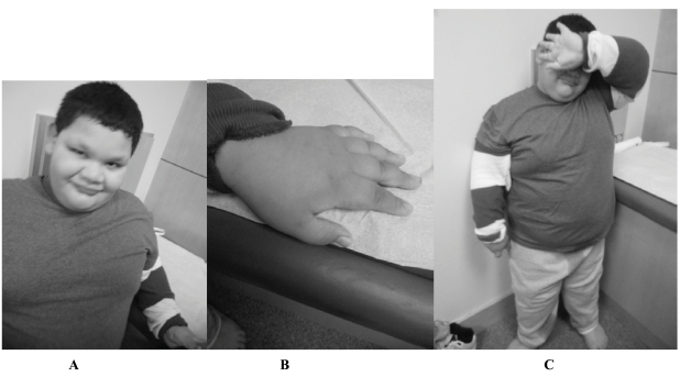 Fig. (1). A, B, & C Prader-Willi Phenotype