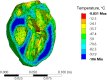 An example of temperature distribution in the human heart model when rewarmed with nanoparticles while following a thermal protocol design for the rat heart model (Case II)