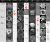 Atypical uterine mass evaluation for leiomyosarcoma (LMS) and its
mimickers: application of the atypical uterine mass flowchart. This figure
demonstrates the real-time application of the Figure 3 flowchart, beginning
with assessment for uterine mass enhancement in column 2. As the columns
progress to the right, the various features in the top row are applied. If
the mass meets criteria for further analysis, an arrow is seen in the box,
indicating that the next feature be applied. Once the mass is determined to
fit benign criteria, a stop symbol is shown and subsequent sequences to the
right are grayed out, indicating that these features should not be
evaluated. Masses characterized as benign according to this imaging
flowchart analysis do not warrant additional work-up from an imaging
perspective. Clinical treatment of such masses can proceed along standard
gynecologic management of benign leiomyomas. All images were acquired in the
axial plane, except for the T2-weighted image in the second row, which was
acquired in the coronal plane. Apparent diffusion coefficient (ADC) is
expressed in square millimeters per second × 10−3. b1000 = b
value of 1000 sec/mm2, CE = contrast-enhanced, DWI = diffusion-weighted
imaging, endo = endometrium, int. = intermediate, STUMP = smooth muscle
tumor of unknown malignant potential, T2WI = T2-weighed imaging.