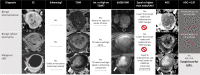 Difficult atypical uterine mass lesion evaluation using the atypical
uterine mass flowchart. This figure demonstrates the real-time application
of the Figure 3 flowchart, beginning with assessment for uterine mass
enhancement in column 2. As the columns progress to the right, the various
features in the top row are applied. If the mass meets criteria for further
analysis, an arrow is seen in the box, indicating that the next feature be
applied. Once the mass is determined to fit benign criteria, a stop symbol
is shown and subsequent sequences to the right are grayed out, indicating
that these features should not be evaluated. Masses characterized as benign
according to this imaging flowchart analysis do not warrant additional
work-up from an imaging perspective. Clinical treatment of such masses can
proceed along standard gynecologic management of benign leiomyomas. Note the
important role of the diffusion-weighted imaging (DWI) sequence with a b
value of 1000 sec/mm2 (b1000) for distinguishing between leiomyosarcoma
(LMS) and benign leiomyoma subtypes, a key feature initially described by
Abdel Wahab et al (54). All images are in the axial plane. Apparent
diffusion coefficient (ADC) is expressed in square millimeters per second
× 10−3. CE = contrast-enhanced, endo = endometrium, int. =
intermediate, LN = lymph node, STUMP = smooth muscle tumor of unknown
malignant potential, T2WI = T2 weighed imaging.
