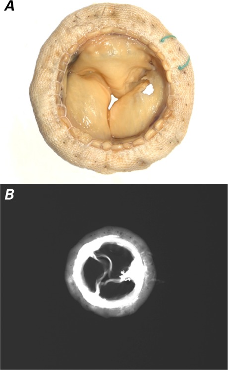 The Mosaic Mitral Valve Bioprosthesis: A Long-Term Clinical and ...