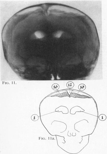 Figs. 11 and 11a