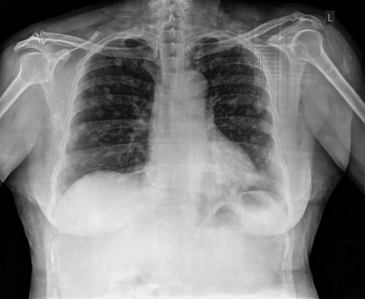 An Interesting Rare Case Report Of Primary Amelanotic Melanoma With Distant Metastasis PMC