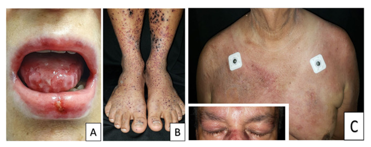 Immune-Mediated Cutaneous Paraneoplastic Syndromes Associated With ...