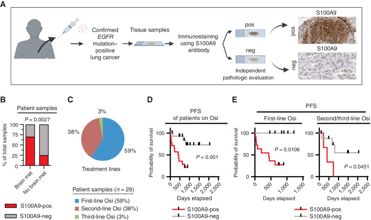 Figure 4. High S100A9 expression is associated with brain metastasis and shorter PFS in patients with osimertinib-treated lung cancer. A, Schematic representation of the analysis of patient samples for S100A9 expression in cancer cells. S100A9 immunostaining was performed on tissue specimens (biopsies/resected material) from 29 patients with lung cancer with a validated EGFR mutation that were obtained prior to osimertinib treatment. The immunostained samples were scored by independent pathologists as either S100A9-positive (any percentage of clear, positive intracellular S100A9 staining in cancer cells) or S100A9-negative (no detectable S100A9 staining in cancer cells). neg, S100A9-negative; pos, S100A9-positive. B, Graphical representation of the association between S100A9 expression in the patient tissue specimens described in A and the development of brain metastasis (met) for 26 patients with a clinical annotation for the presence or absence of brain metastasis at diagnosis (three of 29 patients had unknown brain metastasis status at diagnosis). The P value was determined by a χ2 test: n = 10 samples from patients with brain metastasis and n = 16 samples from patients without brain metastasis. C, Distribution of patients on first-, second-, and third-line osimertinib (Osi) treatment from the 29-patient cohort described in A. D, Kaplan–Meier plot for the PFS of osimertinib-treated patients from the combined cohort described in A. Data were analyzed using the log-rank test: χ2  =  10.74, degrees of freedom (d.f.)  =  1, P = 0.0001, n = 29 patients. Patients who had not progressed at the time of analysis were censored. E, Kaplan–Meier plot for PFS of the osimertinib-treated patients described in A and C. Data were analyzed using the log-rank test. For first-line osimertinib-treated patients: χ2  =  6.011, d.f.  =  1, P = 0.0106, n = 17; for second- and third-line osimertinib-treated patients: χ2  =  4.015, d.f.  =  1, P = 0.0451, n = 12. Patients who had not progressed at the time of analysis were censored.