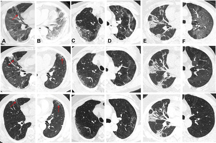 Images show changes in CT findings of lung abnormalities for six patients with COVID-19 at baseline (top row) during the acute illness, at 6 months (middle row), and 1 year (bottom row) after hospital discharge. Middle and bottom rows show (A) persisting traction cylindrical bronchiectasis; (B) persisting subpleural bronchiectasis; (C) persistent honeycombing with slightly reduced extension; (D) partial resorption of residual opacifications; (E) static radiologic changes; and (F) complete radiologic resolution. (Figure F [top and middle rows] reprinted, with permission, from reference 1.)