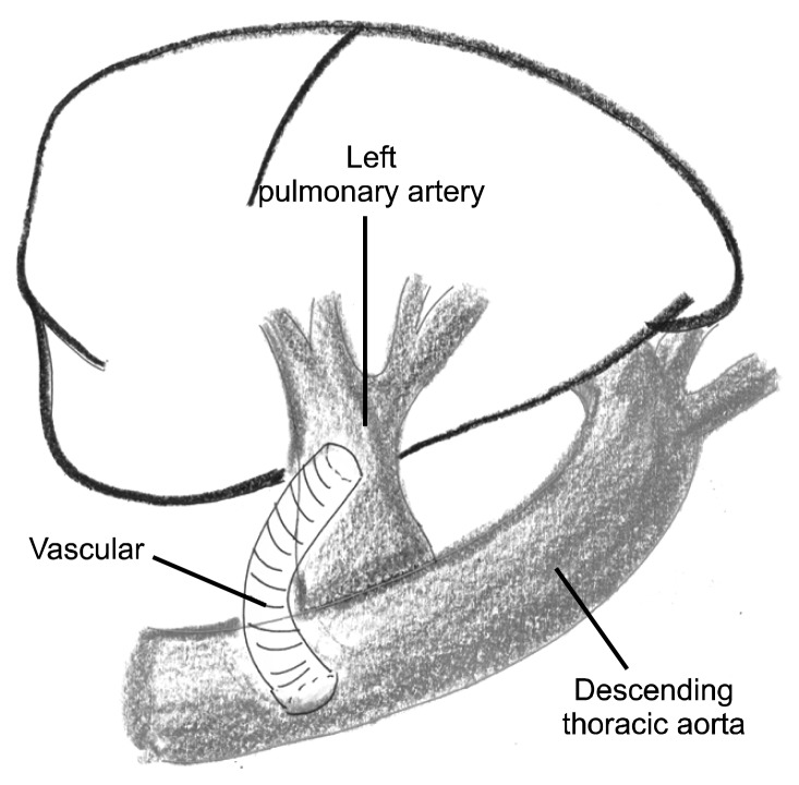 Potts Shunt in Patients with Primary Pulmonary Hypertension - PMC