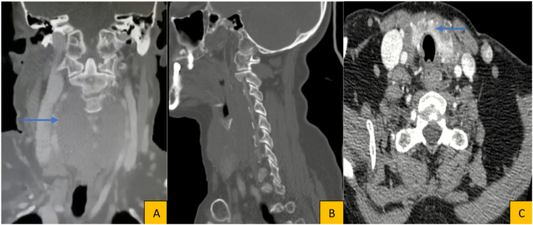 Primary synovial sarcoma of thyroid gland: A case report and review of ...