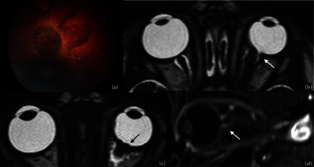 Congenital Malformations of the Eye: A Pictorial Review and Clinico ...