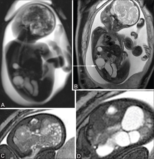 Fetal MRI: A pictorial essay - PMC