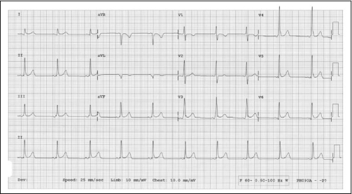 ECG Diagnosis: Wolff-Parkinson-White Syndrome - PMC