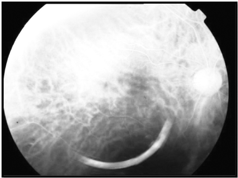 Retinal lipemia as expression of hyperchylomicronemia syndrome - PMC