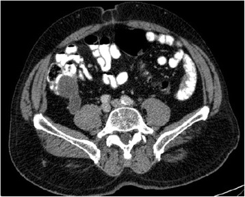 Acute appendicitis, inflammatory appendiceal mass and the risk of a ...