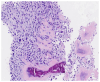 Figure 7. Puncture patholog y showed that the lesion tissue contained anaplastic sarcoma cells and osteoid matrix produced by sarcoma cells. The anaplastic sarcoma cells were fusiform, round–like, wit...