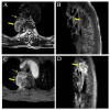 Figure 5. MR image of after esophageal cancer surgery. (A) T2WI shows that no obvious thickening of the anastomotic tube wall (thin arrow) and mass shadows (thick arrow) with patches of low signal can...