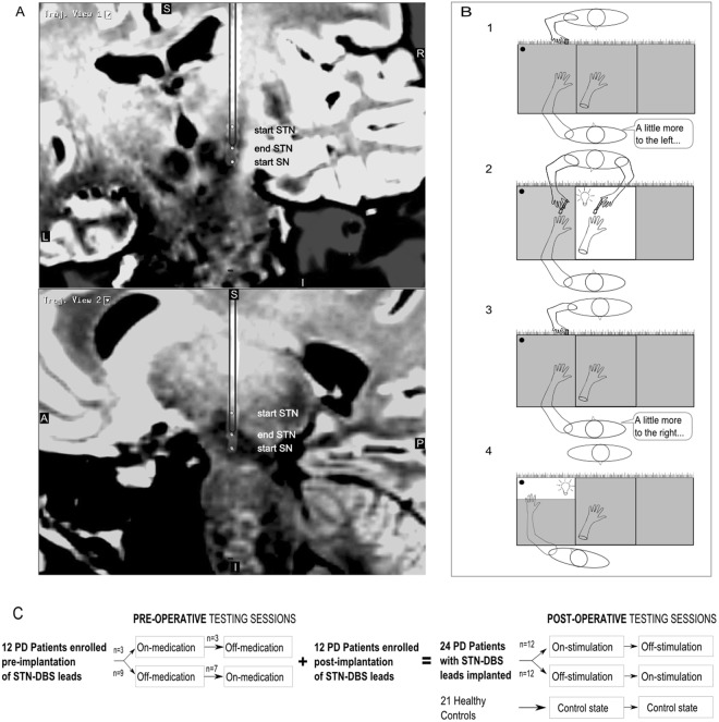 Deep Brain Stimulation For Parkinson’s Disease Changes Perception In 