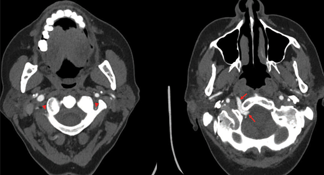 Axial CT-angiogram images demonstrating hypoplastic vertebral arteries (arrowheads) and a PHA (arrows) coursing through a widened hypoglossal canal