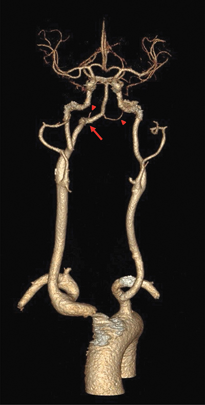 3D-reconstructed CT-angiogram showing a PHA (arrow) and hypoplastic vertebral arteries (arrowheads)