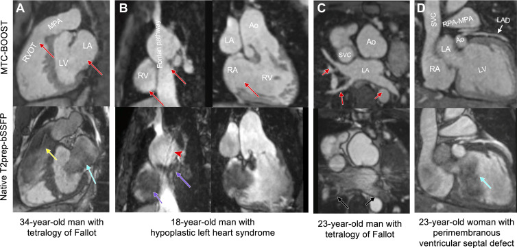 Comparison of MTC-BOOST and native T2prep-bSSFP cardiac MRI. (A) Multiplanar reformatted images in a 34-year-old man diagnosed with tetralogy of Fallot after repair with transannular patch. Severe pulmonary artery regurgitation caused signal voids in the right ventricle, right ventricular outflow tract, and main pulmonary artery because of flow artifact (yellow arrow) in the clinical native sequence. Off-resonance artifact is demonstrated in the left atrium (blue arrow). Artifacts are minimized with the proposed MTC-BOOST sequence (red arrows). (B) Multiplanar reformatted images in an 18-year-old man with hypoplastic left heart syndrome after total cavopulmonary connection completion with a fenestrated lateral tunnel Fontan pathway. Signal voids are observed in the lateral tunnel and right atrium because of stagnant flow (purple arrows) in the native T2prep-bSSFP clinical data set, which necessitate further imaging for the exclusion of obstruction. Residual respiratory artifact (red arrowhead) is also present. The MTC-BOOST sequence demonstrates the vascular lumen without substantial artifact and excludes obstruction (red arrows). (C) Multiplanar reformatted images in a 23-year-old man with tetralogy of Fallot after repair with transannular patch, followed by pulmonary valve replacement with homograft due to severe regurgitation. Off-resonance artifacts in the pulmonary veins in the native T2-prep bSSFP sequence (black arrows) impede the sequential segmental anatomic description. Pulmonary venous return can be established in the MTC-BOOST data set (red arrows). (D) Multiplanar reformatted images in a 23-year-old woman with a small perimembranous ventricular septal defect that has not been repaired, causing mild aortic regurgitation. Flow-related artifact in the left ventricle (blue arrow) observed in the clinical native data set is suppressed in the MTC-BOOST data set. The left anterior descending coronary artery is sharply delineated with the research sequence (white arrow), owing to the improved fat suppression. Ao = aorta, LA = left atrium, LAD = left anterior descending artery, LV = left ventricle, MPA = main pulmonary artery, MTC-BOOST = Magnetization Transfer Contrast Bright-and-black blOOd phase SensiTive, RPA = right pulmonary artery, RV = right ventricle, RVOT = RV outflow tract, SVC = superior vena cava, T2prep-bSSFP = T2-prepared balanced steady-state free precession.