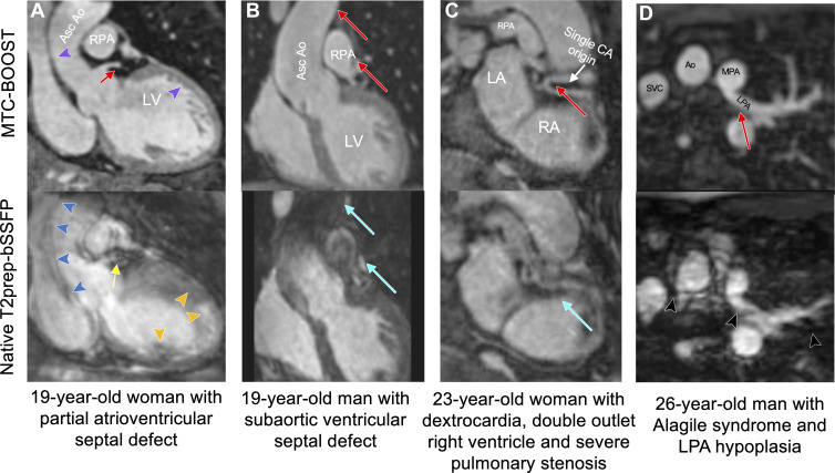 Comparison of MTC-BOOST and native T2prep-bSSFP cardiac MRI. (A) Multiplanar reformatted images in a 19-year-old woman with partial atrioventricular septal defect, after repair, and severe left atrioventricular valve regurgitation. Residual respiratory motion induces blurring in the ascending aorta (blue arrowheads), left ventricle (orange arrowheads), and left main stem (yellow arrow) in the clinical T2prep-bSSFP data set. Respiratory motion is adequately resolved in the MTC-BOOST data set, with clear depiction of the aortic and left ventricular wall (purple arrowheads) and the left main coronary stem (red arrow). (B) Multiplanar reformatted images in a 19-year-old man with subaortic ventricular septal defect and aortic regurgitation secondary to aortic valve prolapse after surgical repair, who had recurrent aortic regurgitation after ventricular septal defect closure and aortic valve repair. Images were acquired in end systole because of high heart rate. Substantial luminal signal loss in the ascending aorta and right pulmonary artery was observed due to flow artifacts (blue arrows). Attenuation of the artifact in the corresponding regions in the MTC-BOOST data set enabled reliable aortic dimensioning (red arrows). (C) Multiplanar reformatted images in a 23-year-old woman with dextrocardia, situs solitus, double-outlet right ventricle, and severe pulmonary stenosis, who was palliated with Hemi-Fontan procedure. Common origin of the coronary arteries from the posterior-facing sinus is well demarcated with the MTC-BOOST sequence (red arrow). Substantial artifact from residual respiratory motion in the clinical T2prep-bSSFP data set (blue arrow) hinders diagnostic certainty. (D) Multiplanar reformatted images in a 26-year-old man with Alagile syndrome and hypoplasia of the left pulmonary artery. Residual respiratory motion in the clinical T2prep-bSSFP data set causes substantial blurring along the course of the left pulmonary artery and ascending aorta, leading to unclear measurements of the respective vascular diameters (black arrowheads). The MTC-BOOST data set resolves the respiratory motion and demarcates the aorta, as well as the proximal and distal course of the left pulmonary artery (red arrow) and its branches. Ao = aorta, Asc = ascending, CA = coronary artery, LA = left atrium, LPA = left pulmonary artery, LV = left ventricle, MPA = main pulmonary artery, MTC-BOOST = Magnetization Transfer Contrast Bright-and-black blOOd phase SensiTive, RA = right atrium, RPA = right pulmonary artery, SVC = super vena cava, T2prep-bSSFP = T2-prepared balanced steady-state free precession.