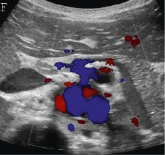 (A,B,C,D) Transverse and sagittal gray-scale and color Doppler ultrasound images of the upper abdominal aorta (white arrow) and (E,F) transverse gray-scale and color Doppler ultrasound images of the superior mesenteric artery (black arrow) show wall thickening and/or mural thrombus, lumen irregularity, and multiple aneurysms. (G,H) Transverse Gray-scale and color Doppler ultrasound images of the abdominal aorta and left renal artery (yellow arrow) show ostial narrowing of the left renal artery.