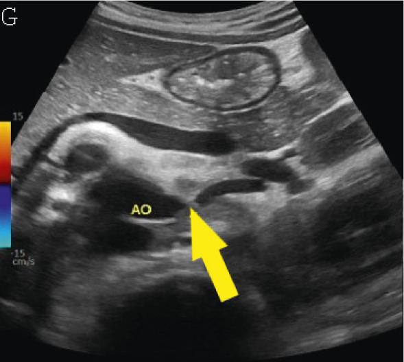 (A,B,C,D) Transverse and sagittal gray-scale and color Doppler ultrasound images of the upper abdominal aorta (white arrow) and (E,F) transverse gray-scale and color Doppler ultrasound images of the superior mesenteric artery (black arrow) show wall thickening and/or mural thrombus, lumen irregularity, and multiple aneurysms. (G,H) Transverse Gray-scale and color Doppler ultrasound images of the abdominal aorta and left renal artery (yellow arrow) show ostial narrowing of the left renal artery.