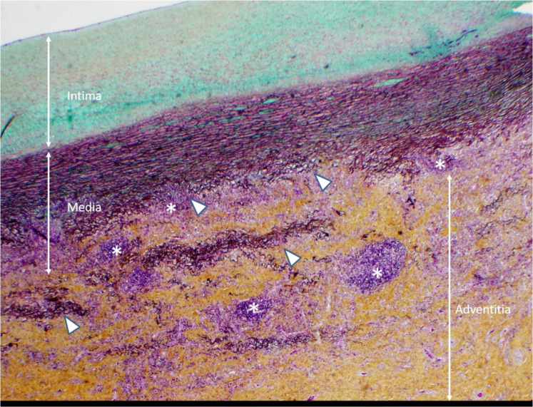 Histopathological slide with Movat stain, 20x magnification. Noninfectious aortitis with patchy perivascular, adventitial and medial lymphocytic infiltrates (*). There is moderate thickening of the intima, variable medial thickening and disruption of elastic media (Δ) and marked, dense fibrotic thickening of the adventitia.