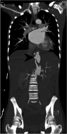 (A) Chest radiograph shows cardiomegaly and an abnormal left paraspinal density in the region of the descending thoracic aorta (arrow). (B, C and D) Coronal contrast-enhanced computed tomographic angiography images of the chest, abdomen and pelvis reveal a diffuse abnormal appearance of the descending thoracic aorta and suprarenal abdominal aorta with lumen irregularity, wall thickening and/or mural thrombus as well as multiple aneurysms (arrowheads). Lack of contrast opacification of the left renal artery and delayed enhancement of the left kidney (white arrow) secondary to renal artery stenosis or thrombosis.