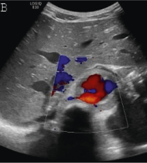 (A,B,C,D) Transverse and sagittal gray-scale and color Doppler ultrasound images of the upper abdominal aorta (white arrow) and (E,F) transverse gray-scale and color Doppler ultrasound images of the superior mesenteric artery (black arrow) show wall thickening and/or mural thrombus, lumen irregularity, and multiple aneurysms. (G,H) Transverse Gray-scale and color Doppler ultrasound images of the abdominal aorta and left renal artery (yellow arrow) show ostial narrowing of the left renal artery.